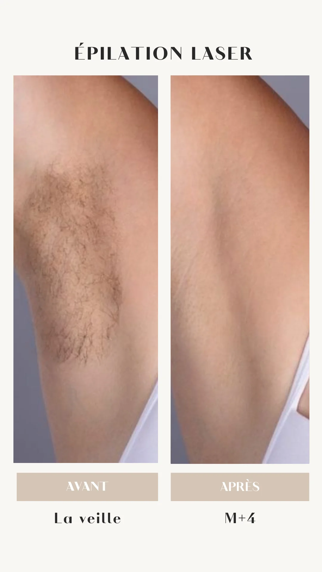 Pack De 6 Séances Epilation Laser Aisselles - Femme - Image 3