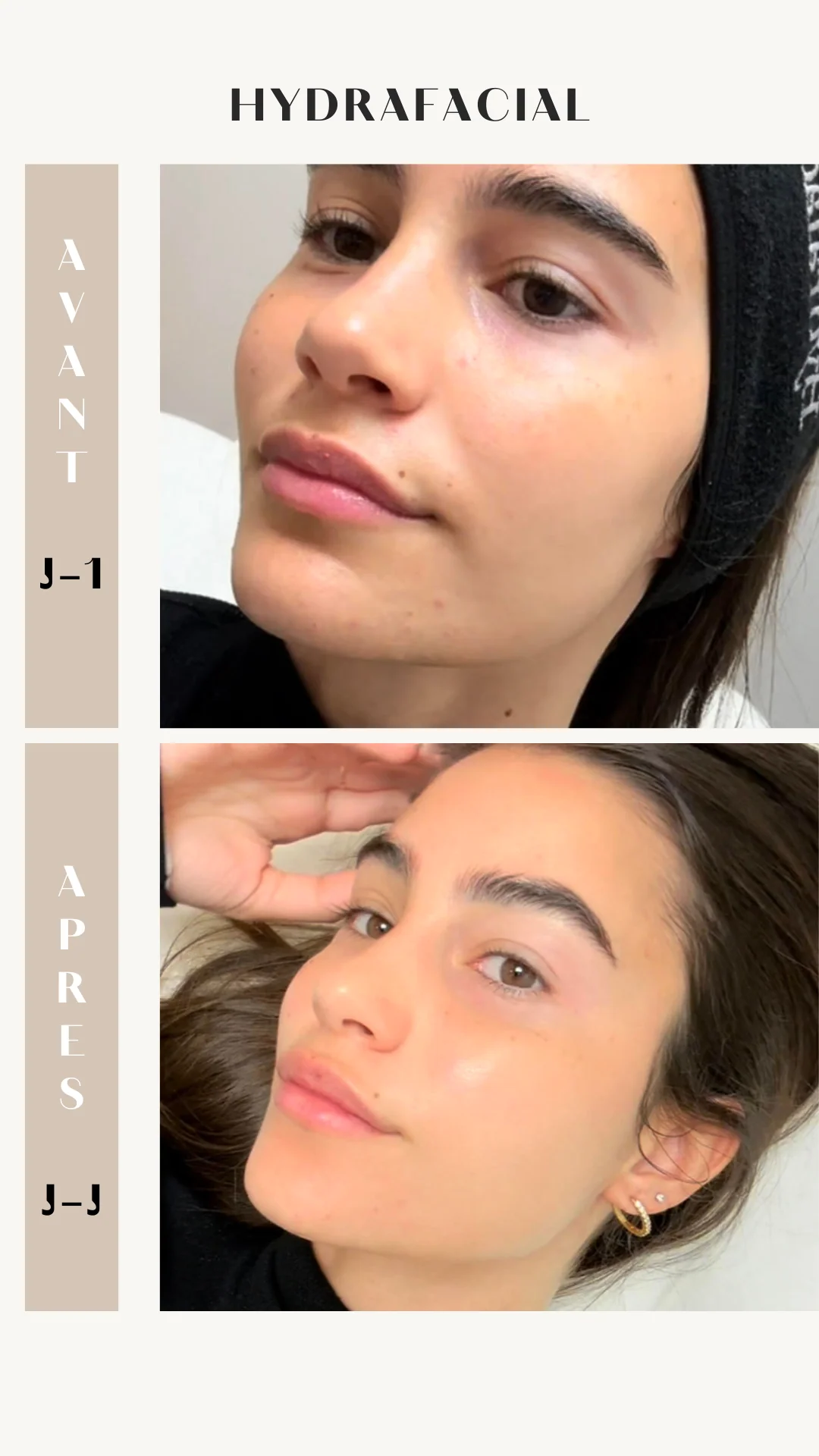 Pack De 3 Séances Hydrafacial Signature - Image 4